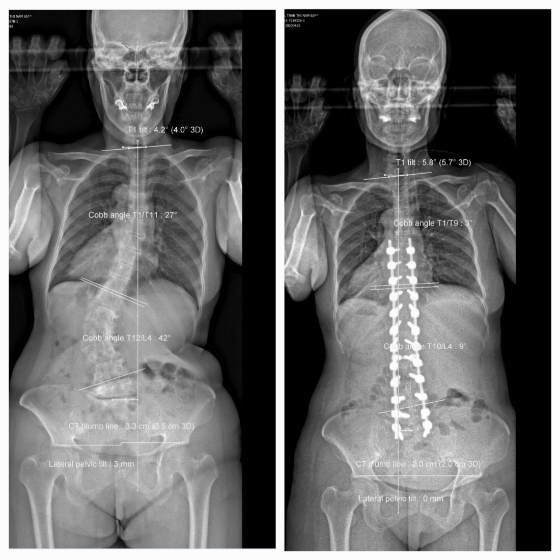 Hình ảnh trước và sau khi phẫu thuật của bà N., ảnh BVCC