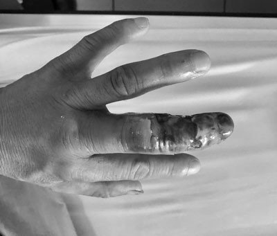 Ngón tay bệnh nhân hoại tử vì đắp thuốc nam chữa rắn cắn
