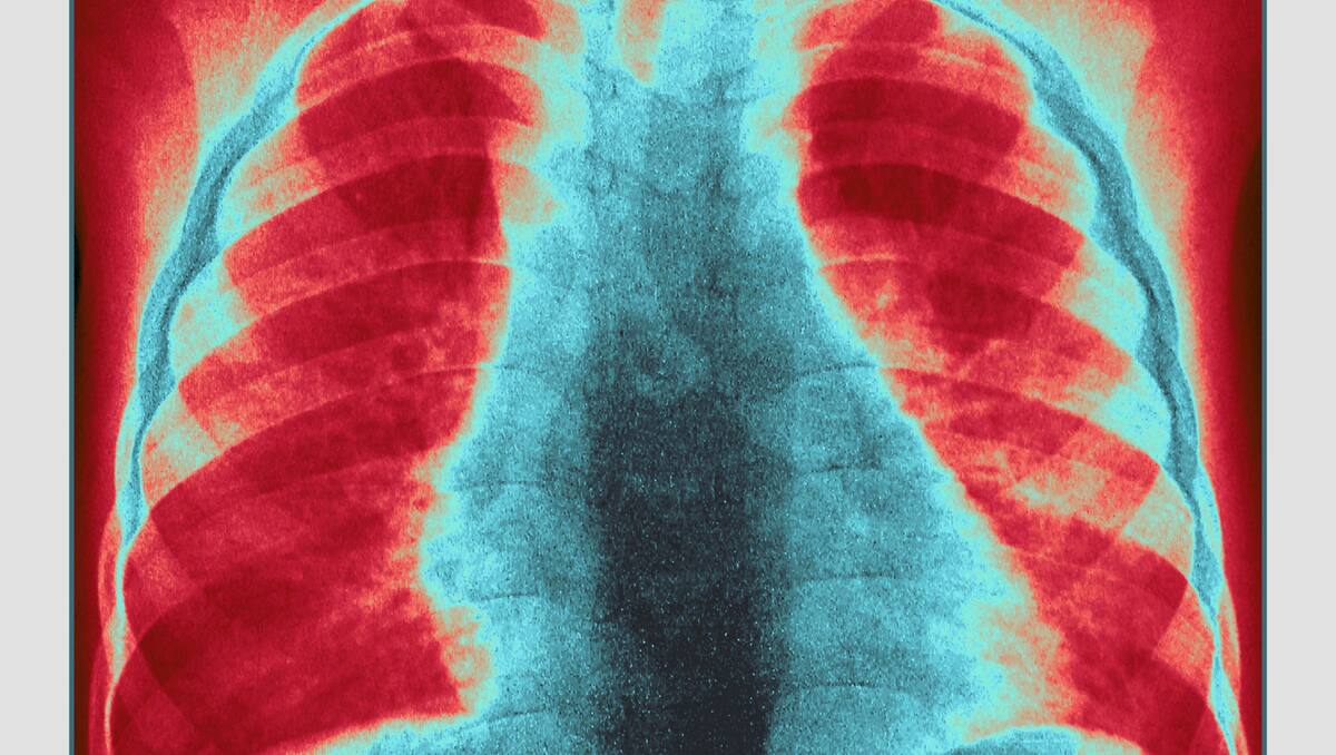 Ảnh chụp X-quang lồng ngực một bệnh nhi mắc viêm phổi, căn bệnh truyền nhiễm nguy hiểm hàng đầu hiện nay với trẻ em. (Ảnh: Getty)