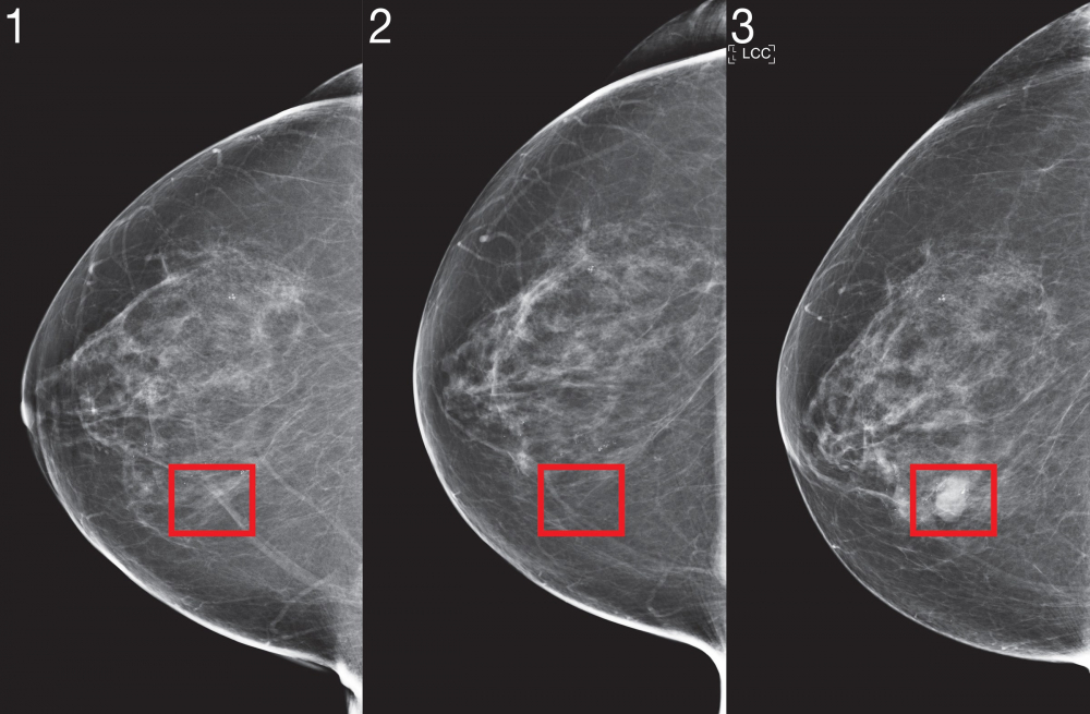 Ảnh chụp X-quang vú một bệnh nhân được thuật toán của AI kết luận là có nguy cơ cao, từ 4 năm trước khi người này được chẩn đoán ung thư vú - Ảnh: WIRED