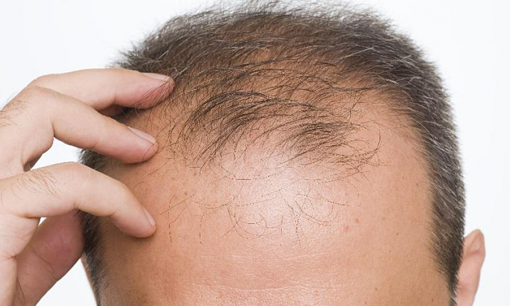Các bác sĩ cảnh báo rụng tóc có thể là biểu hiện của nhiều bệnh lý khác nhau, trong đó có cả bệnh truyền nhiễm (ảnh minh họa)