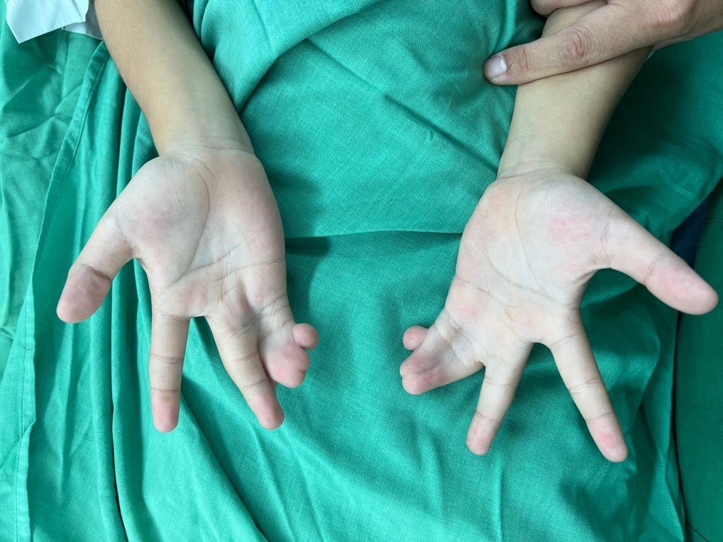 Đôi tay của bé P. trước khi được phẫu thuật