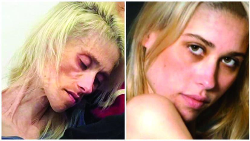 Từ một cô gái bình thường, khỏe mạnh (phải) người mẫu Karin Bauman chỉ còn thân hình da bọc xương (trái) và qua đời ở tuổi 35 vì chứng chán ăn tâm thần