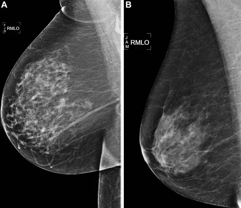 AI xác định được cả rủi ro ung thư bị bỏ sót, cũng như các dấu hiệu mô vú là chỉ báo ung thư trong tương lai