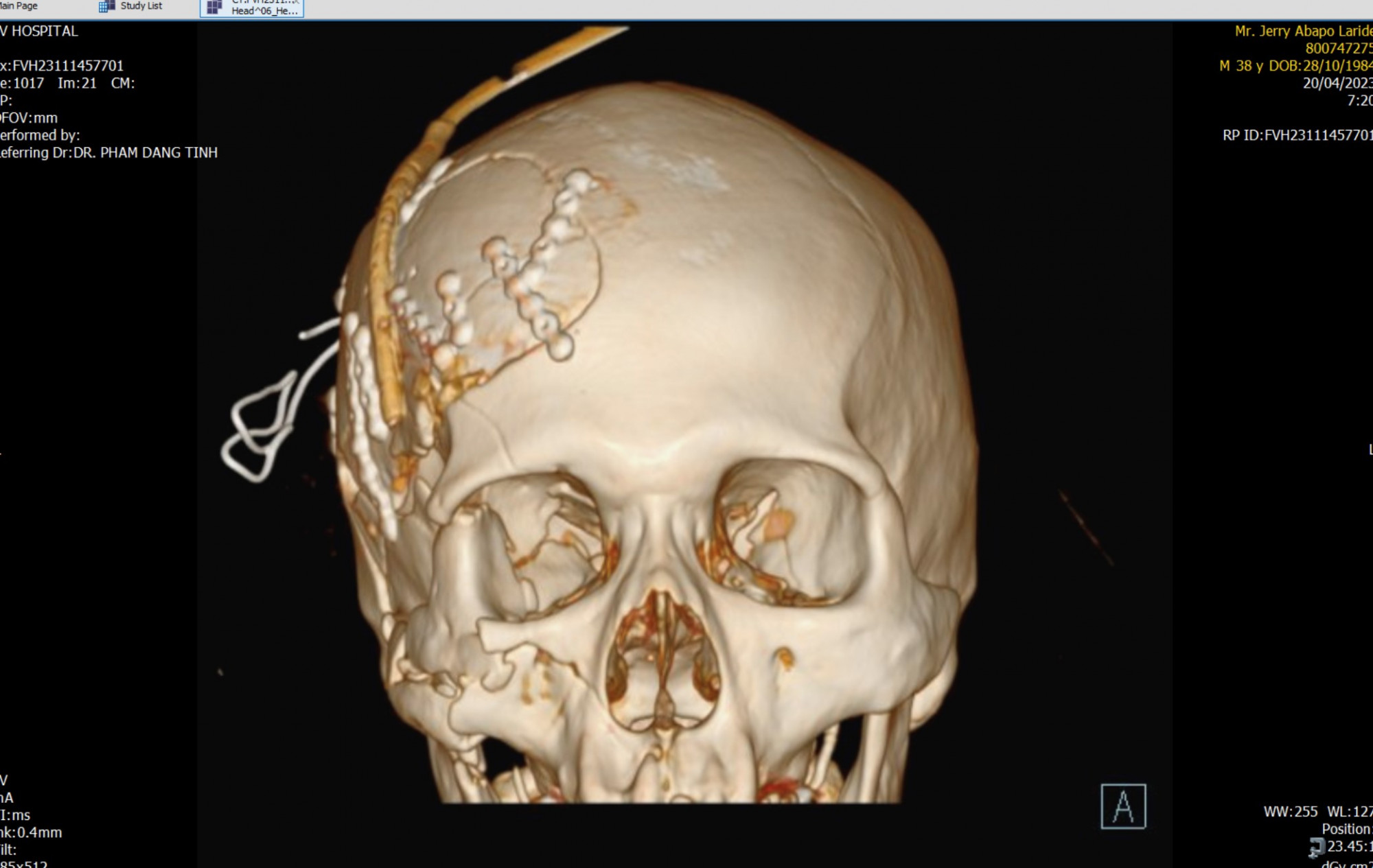 Hình chụp ConeBeamCT 3 chiều cho thấy phần xương mặt bị vỡ nát. Ảnh do bệnh viện cung cấp