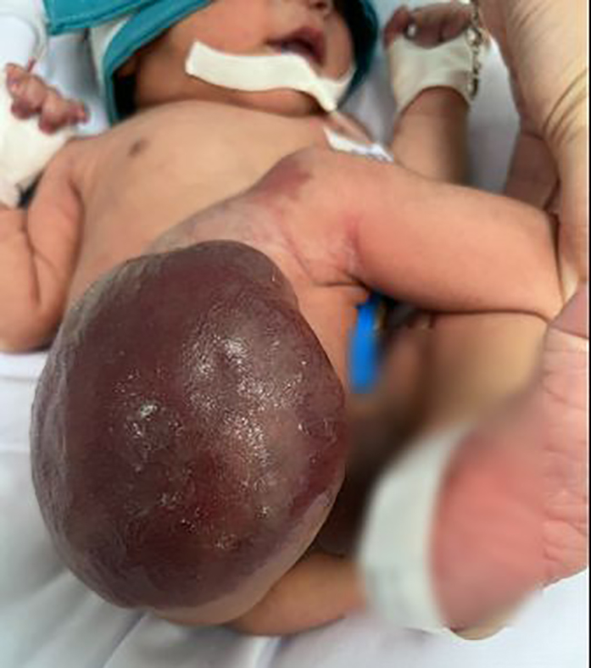 Khối bướu máu khổng lồ ở vùng mông, đùi phải của bé trai sơ sinh, ảnh BVCC