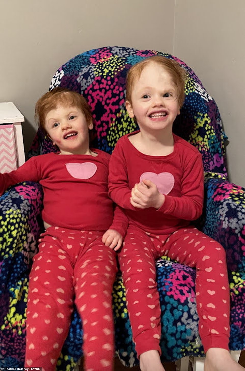 Hai bé gái song sinh dính liền Abby và Erin Delaney phát triển mạnh khỏe sau ca phẫu thuật tách rời năm 2017 