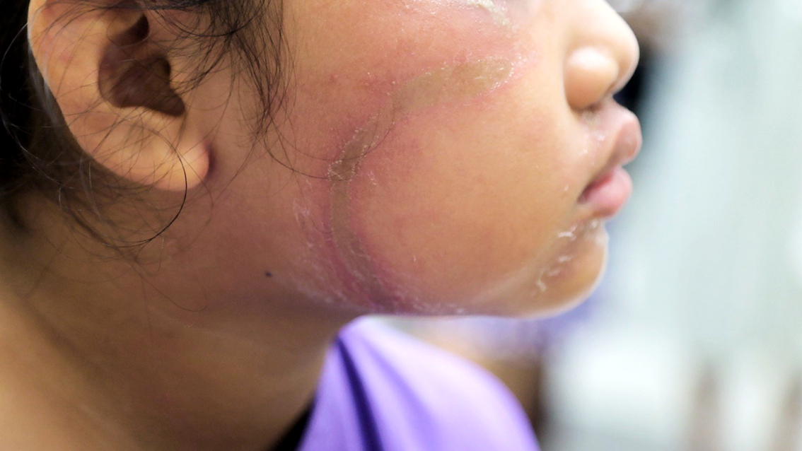 Mặt của em H. bị viêm da tiếp xúc do kiến ba khoang, phải vào Bệnh viện Da liễu TPHCM điều trị - ẢNH: S.L.
