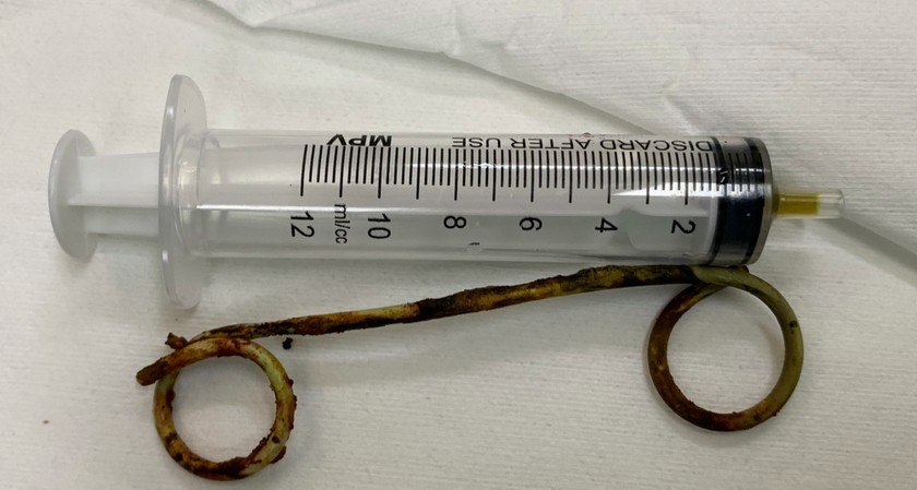 Một stent nhựa được lấy ra từ ống mật chủ của cụ bà N.T.T (ngụ huyện Thạnh Trị, tỉnh Sóc Trăng) sau 6 năm.