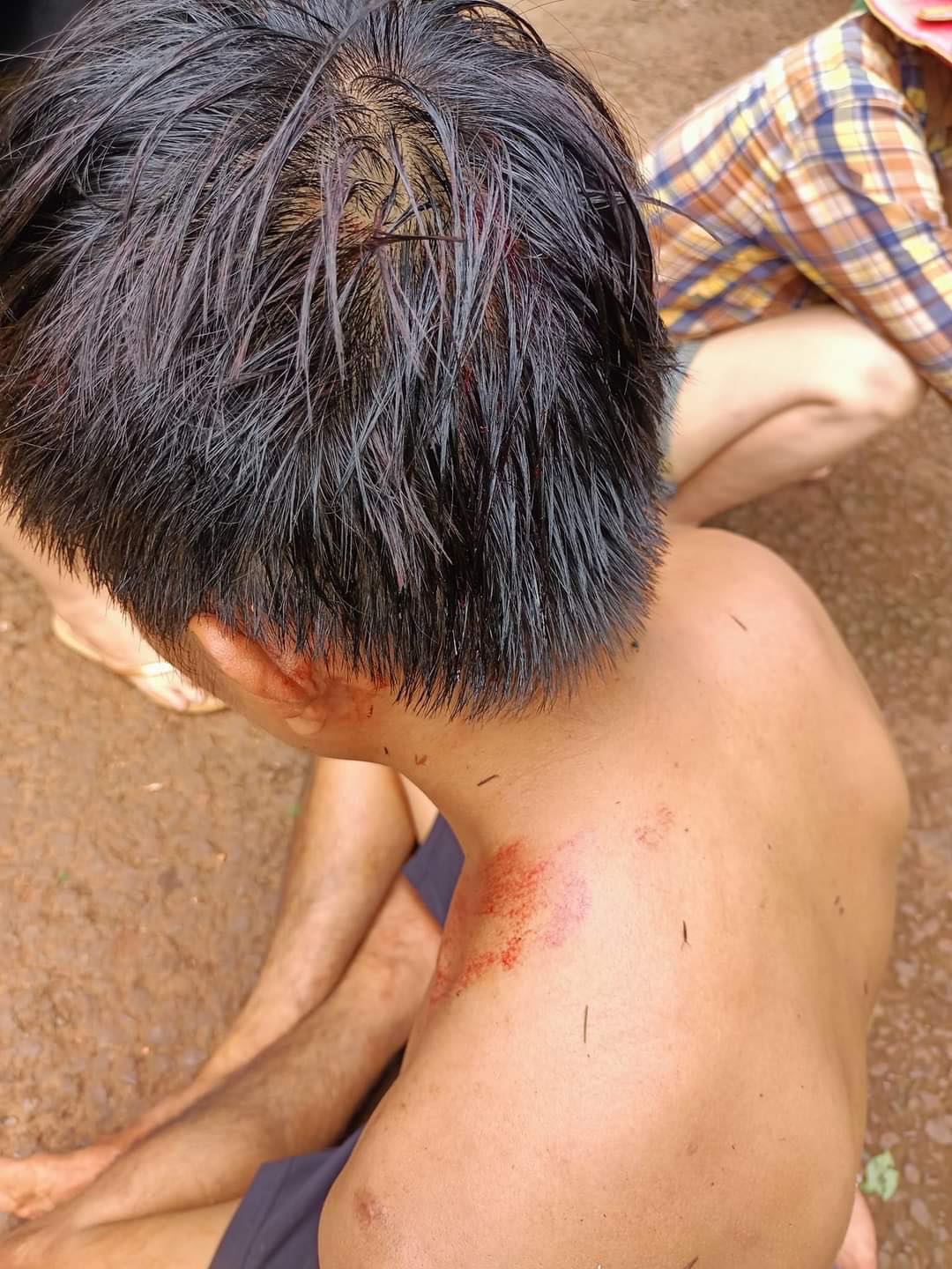 Nngay sau khi bị đánh, trên đầu và tai anh Hoàng xuất hiện nhiều vết thương tích, chảy máu