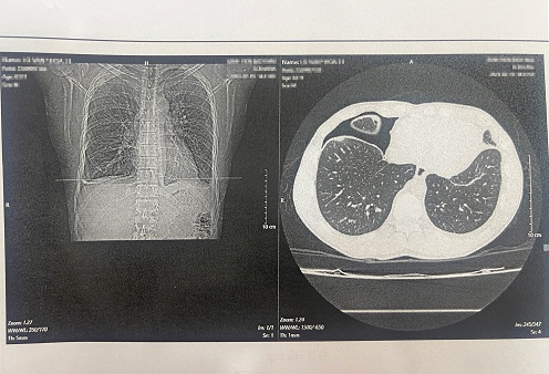 Hình ảnh chụp phim trên bệnh nhân sán lá phổi