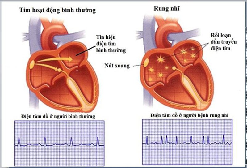 Triệu chứng của bệnh rung nhĩ rất khó phát hiện