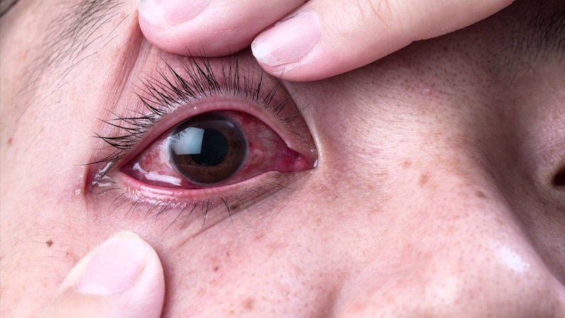 Bệnh đau mắt đỏ đang có dấu hiệu tăng