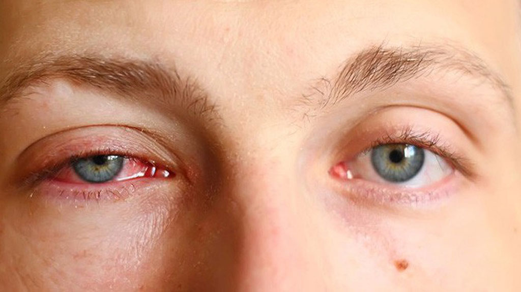 Bệnh đau mắt đỏ - Hình minh họa