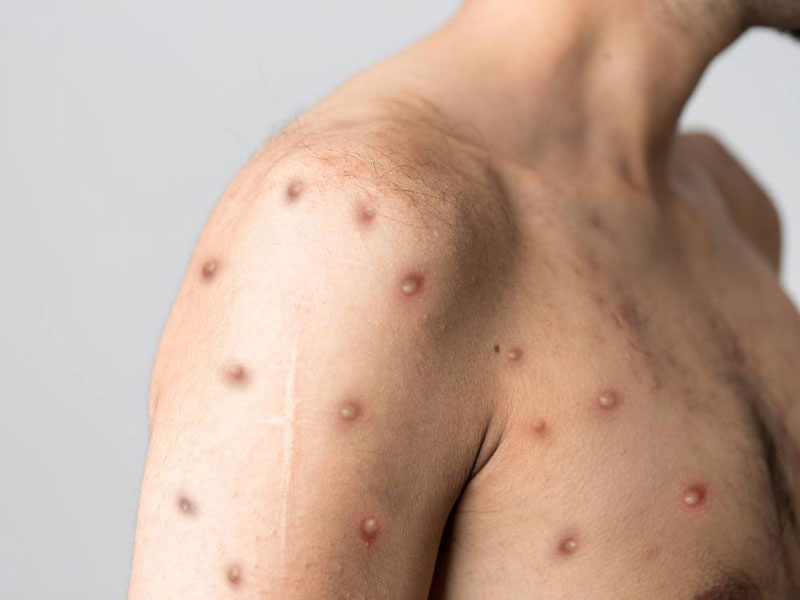 kết quả giải mã gene cho thấy, Đây là chủng virus monkeypox thuộc kiểu gene C1 của Clade IIb