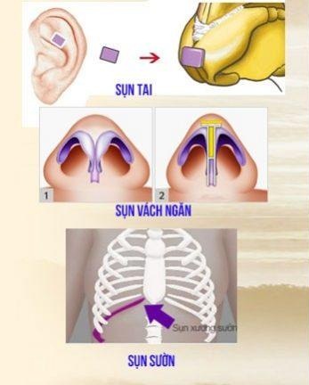 Nhiều loại sụn tự thân được ứng dụng trong nâng mũi thẩm mỹ