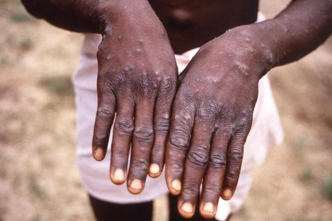 WHO cảnh báo về các trường hợp nhiễm đậu mùa khỉ ở CHDC Congo