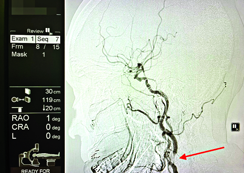 Hình ảnh động mạch cảnh của một bệnh nhân trước (trái) và sau khi được đặt stent động mạch cảnh - ẢNH: T.Y.
