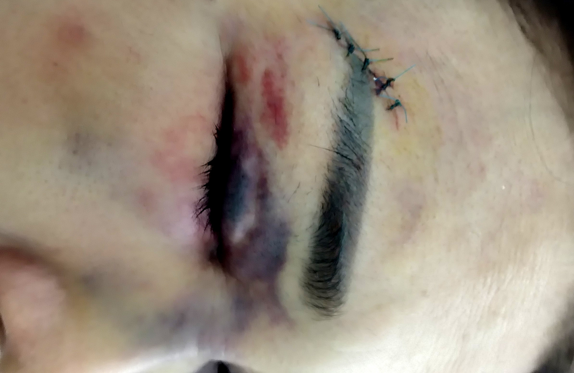 Mặt bà M. bị rách, sưng húp sau khi bị chồng đánh đập - Ảnh: Khánh Trung