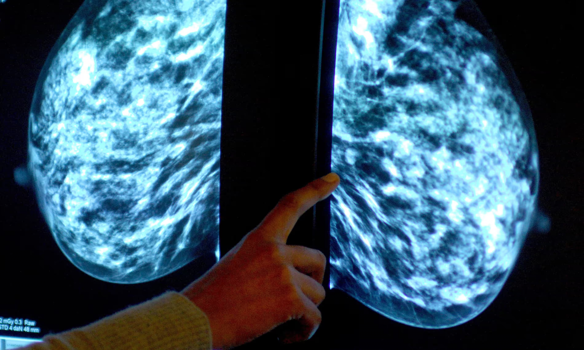 Nhân viên y tế đang phân tích ảnh chụp X-quang vú — Ảnh: Press Association