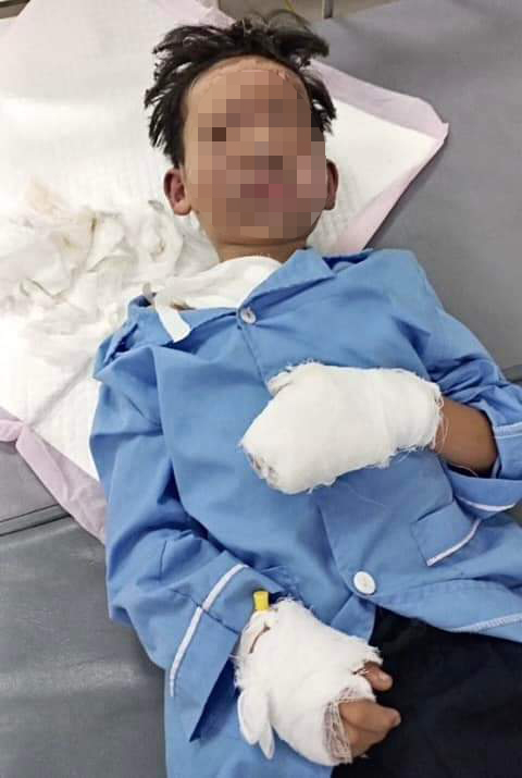 Bé trai 8 tuổi bỏng nặng vì laptop phát nổ