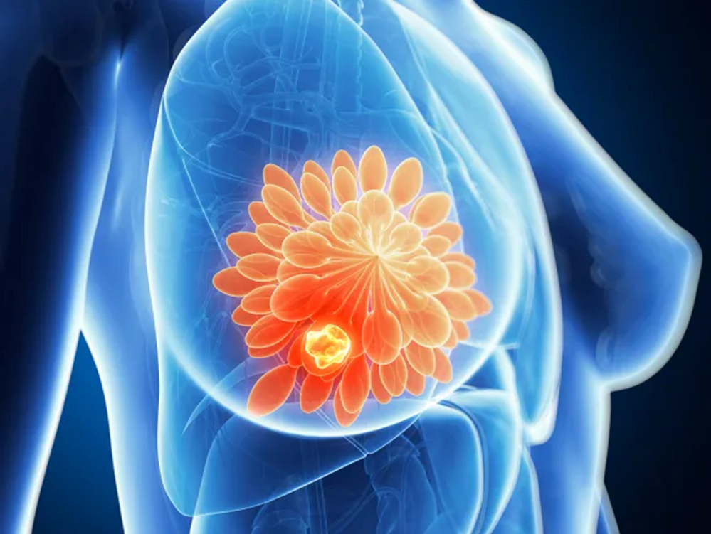 Mô hình 3D thể hiện các khối u ung thư vú — Ảnh: Getty Images