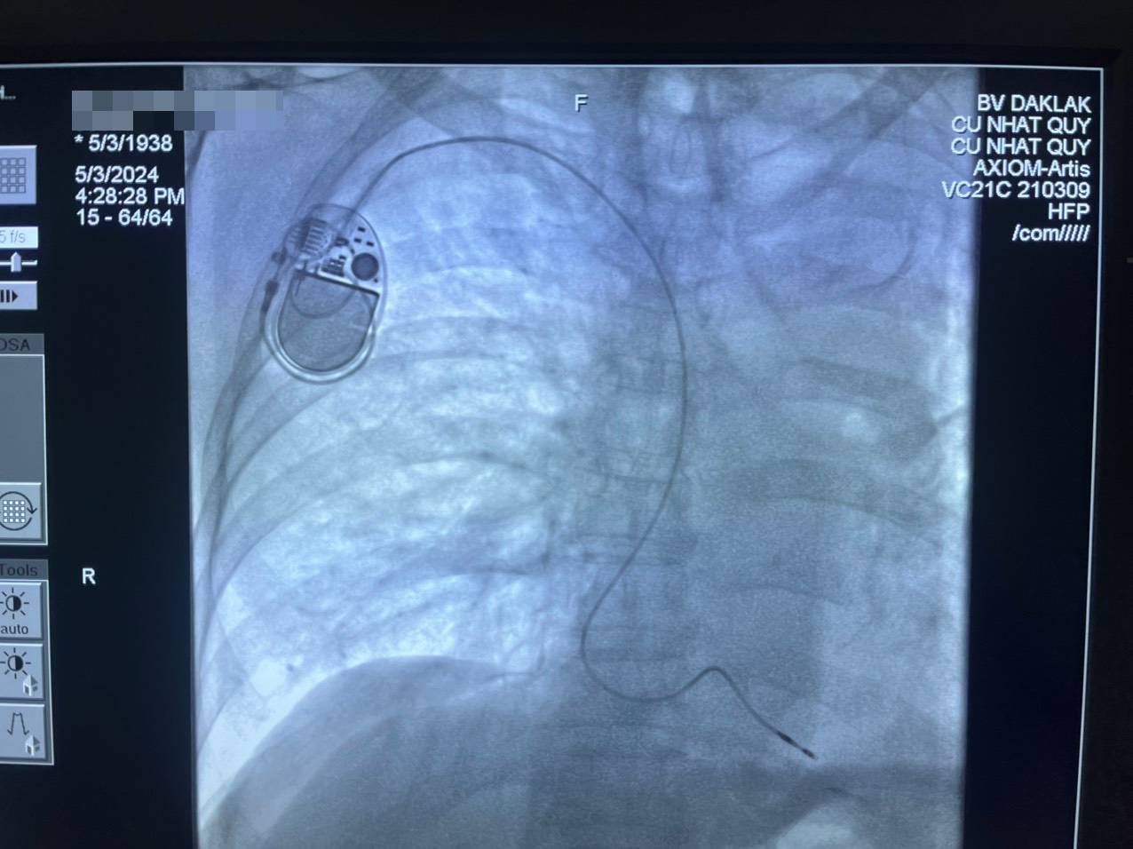  Bệnh nhân K. được cấy máy tạo nhịp tim vĩnh viễn