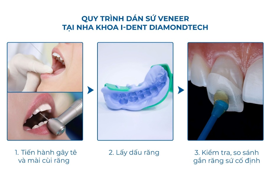 Quy trình dán sứ Veneer tại Nha khoa I-Dent DiamondTech