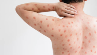 Trung Quốc phát hiện ra cụm chủng Mpox mới