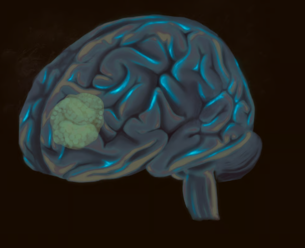 Một khối u đa dạng glioblastoma, được nhìn thấy ở thùy trán của não. Ảnh: Shutterstock