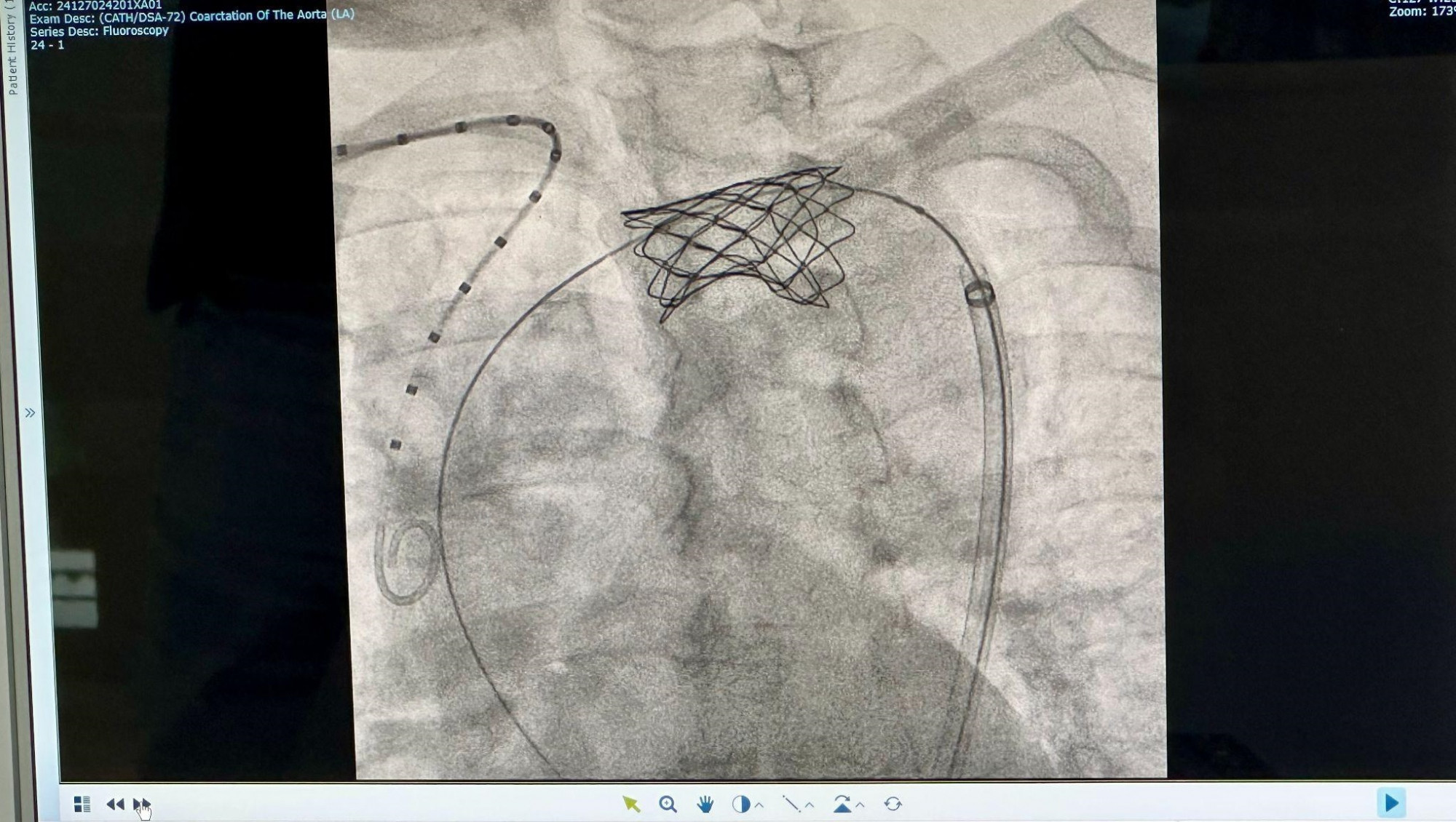 Hình ảnh stent động mạch chủ được chụp lại sau khi đã đặt thành công - Ảnh: FV