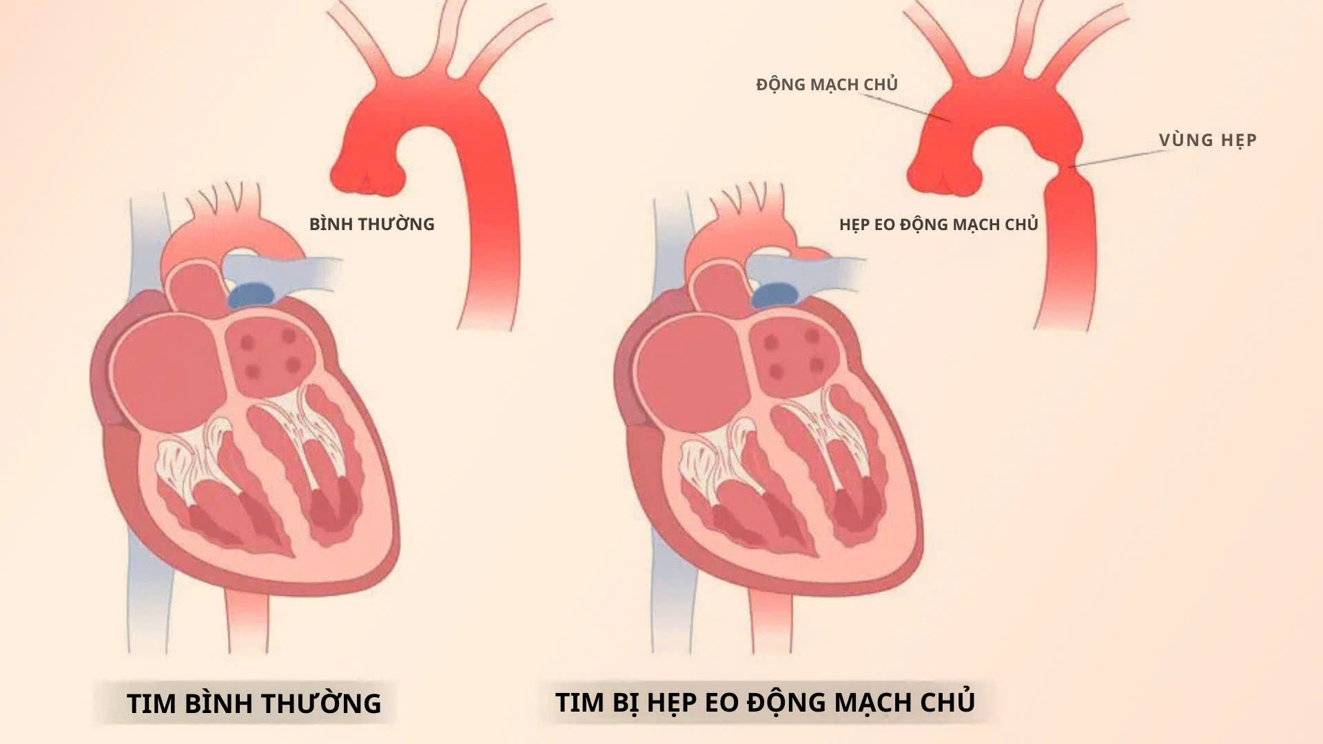 Hình minh họa chứng hẹp eo động mạch chủ bẩm sinh gây hạn chế lưu thông máu từ tim tới các cơ quan - Ảnh: Freepik