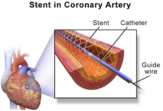 Thiết bị gọi là stent giúp mở rộng lòng mạch máu, cho phép máu lưu thông dễ dàng hơn,