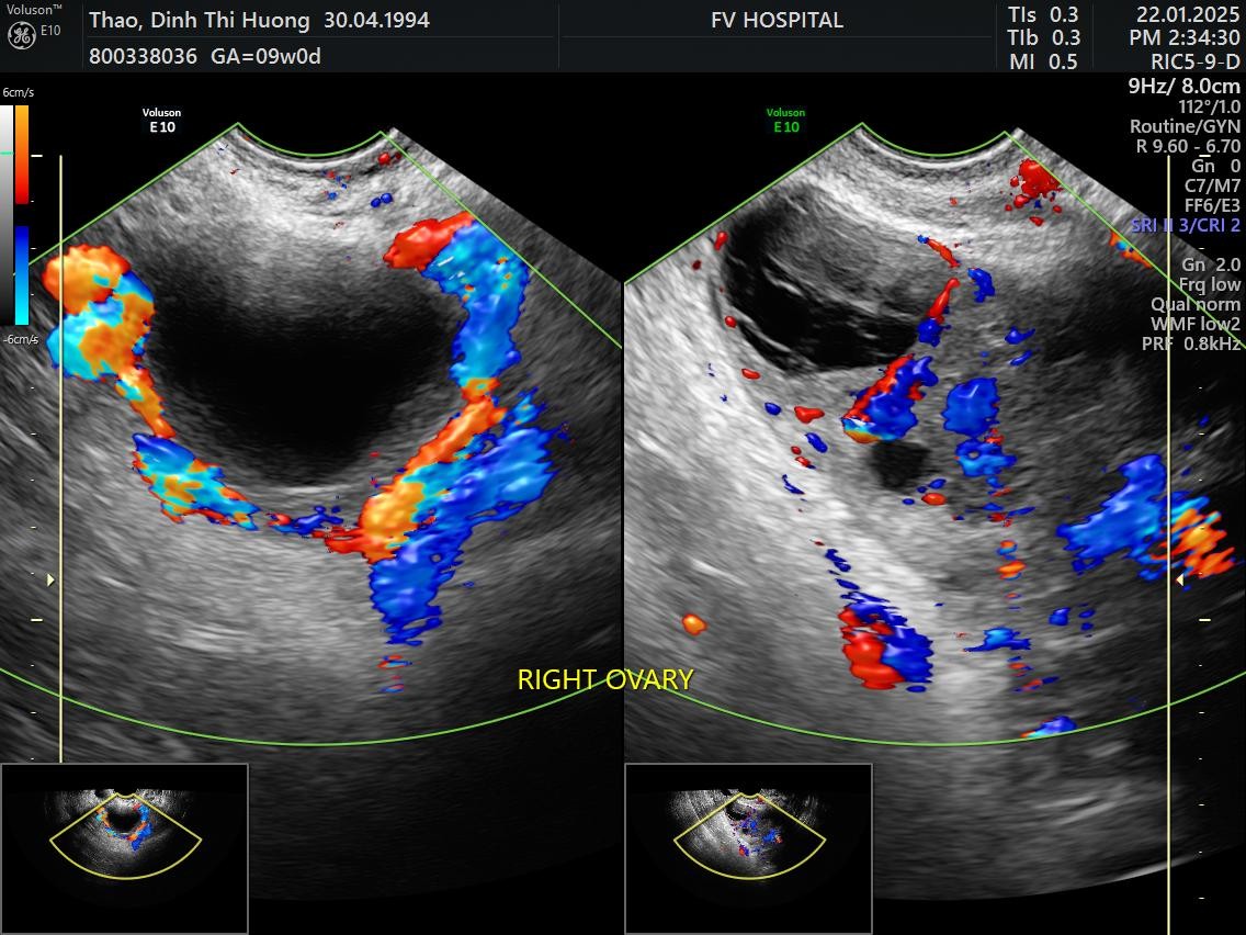 Hình ảnh buồng trứng được tưới máu lại bình thường trên siêu âm tái khám sau một tuần (bên trái là buồng trứng bình thường, bên phải là buồng trứng từng bị xoắn). Ảnh: FV