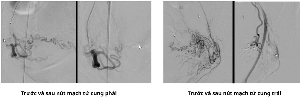 Hình trước và sau khi thực hiện thủ thuật nút mạch tử cung