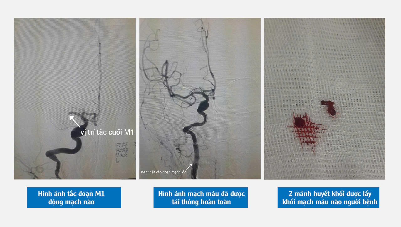 Hình ảnh cho thấy người bệnh bị nhồi máu não và huyết khối được lấy ra từ mạch máu não người bệnh - ảnh: BVCC