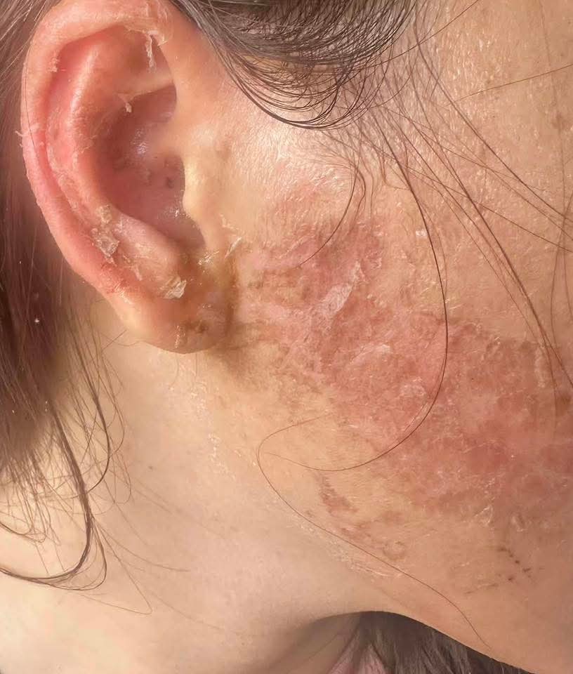 Da trên vùng mặt của chị M. bị bỏng mà nguyên nhân theo đơn tố giác là do bị đổ axit non. Ảnh: nguồn Facebook