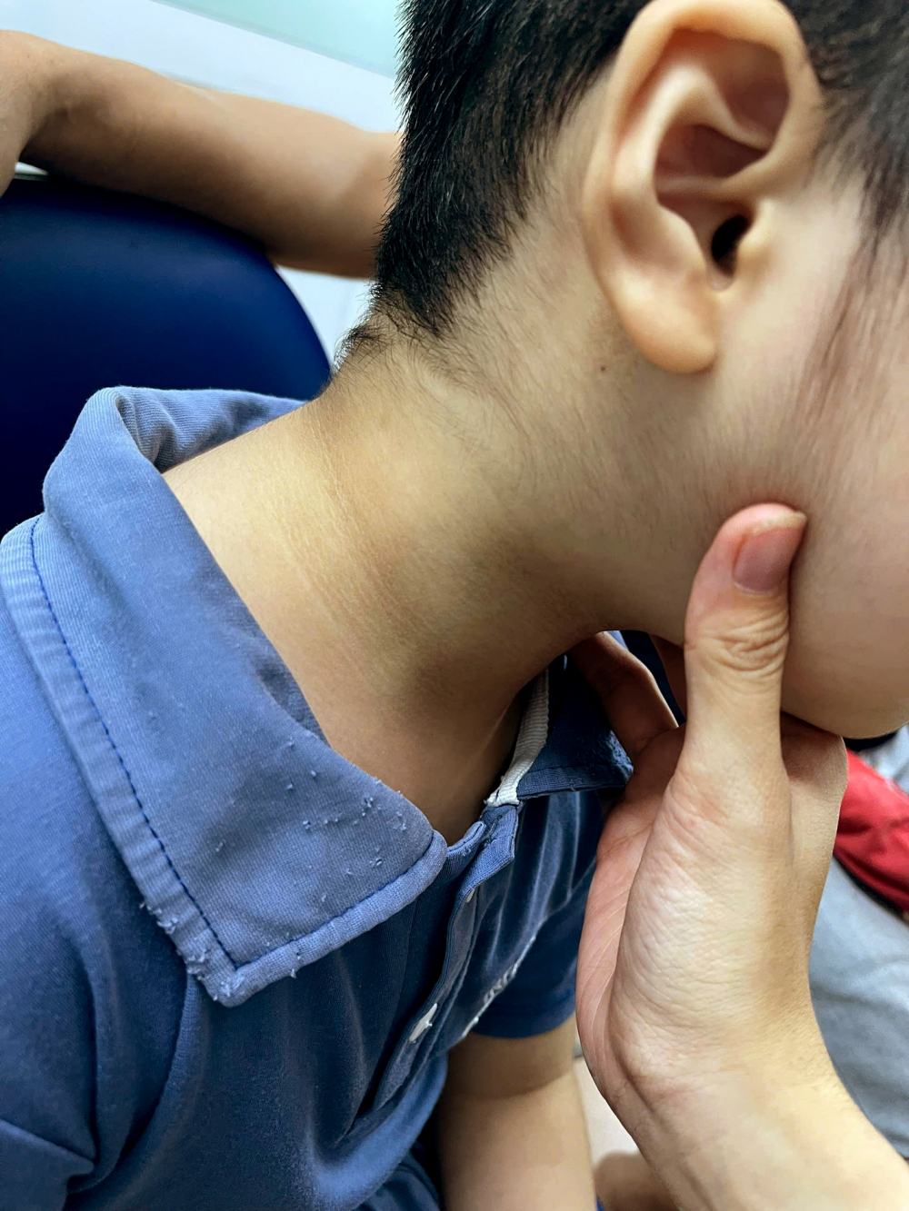 Bé V.V.D. có gai đen ở cổ,  mặt tròn lên, biểu hiện  của hội chứng Cushing  do lạm dụng corticoid kéo dài - ẢNH: N.K.