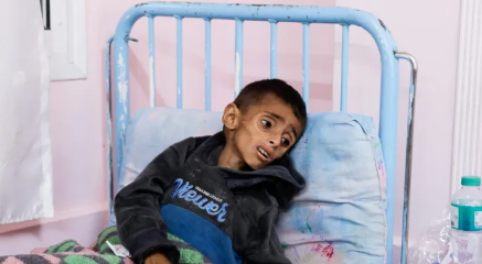 Một đứa trẻ bị suy dinh dưỡng tại một bệnh viên ở Gaza. Ảnh: Aljazeera