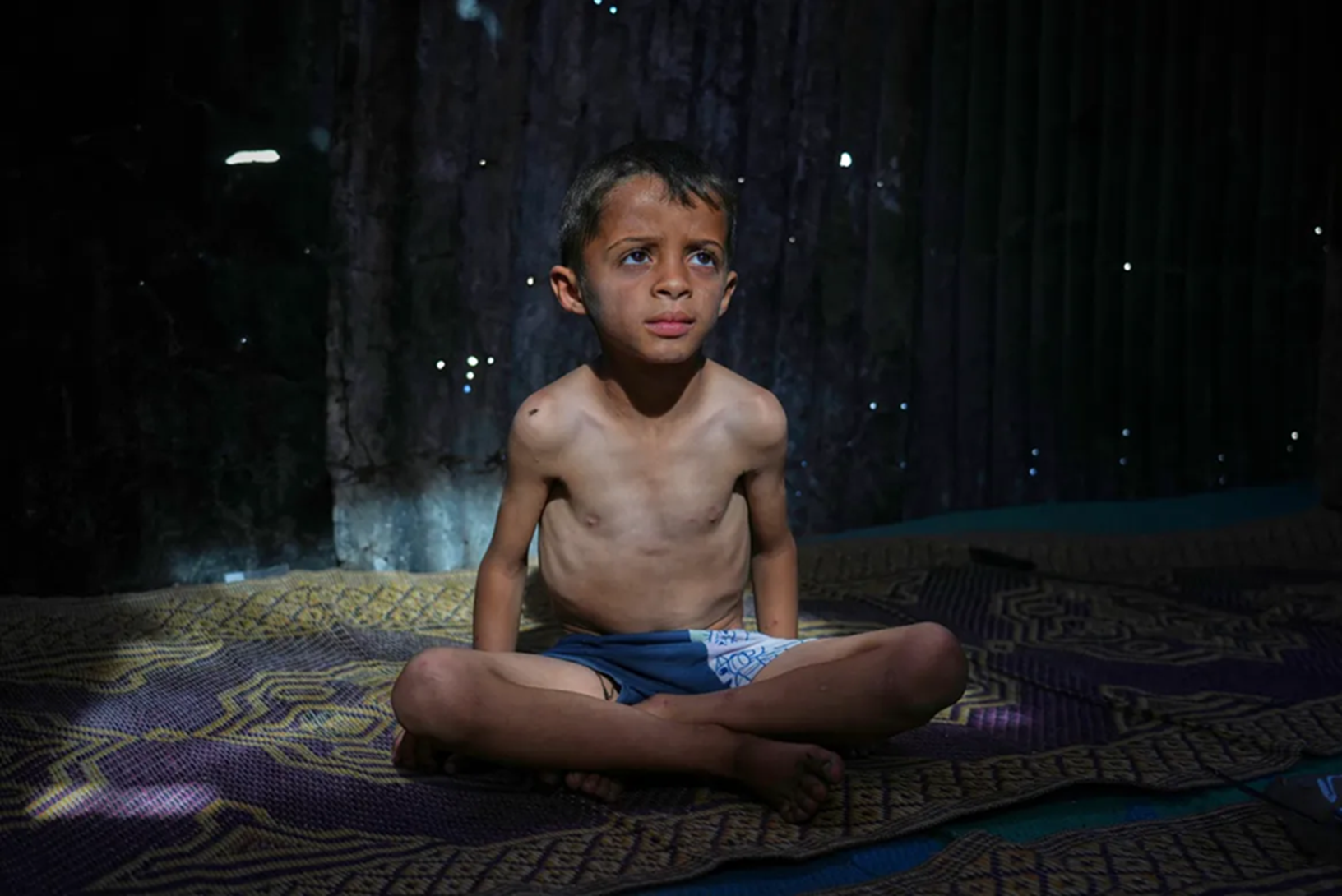 Bé Ahmed el-Sheikh Eid, 7 tuổi, bị suy dinh dưỡng, tại một trại tị nạn dành cho người Palestine ở al-Mawasi — Ảnh: Abdel Kareem Hana