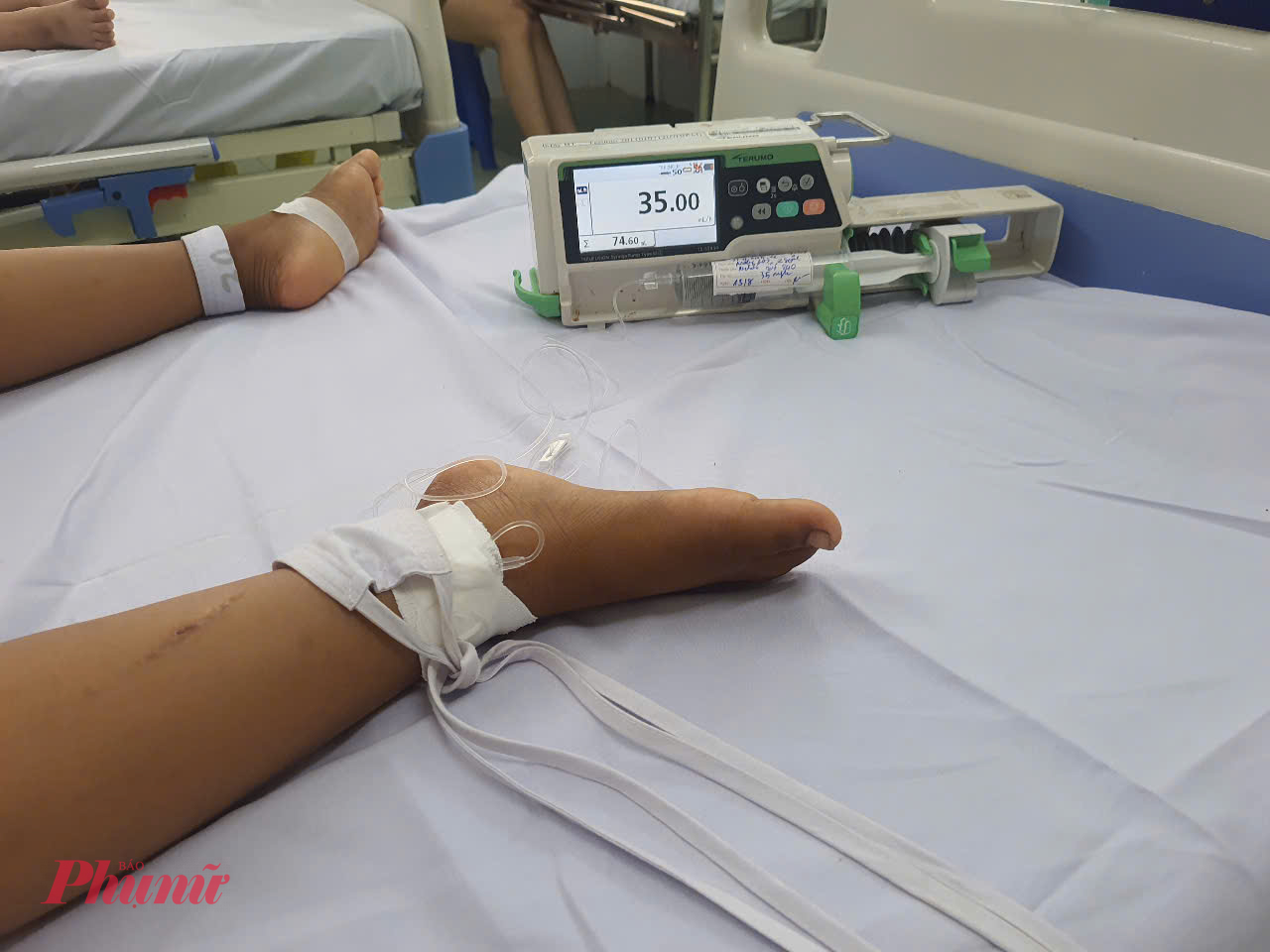 Bệnh nhi bị sốt xuất huyết nặng đang được truyền kháng sinh tại Bệnh viện Nhi đồng 2