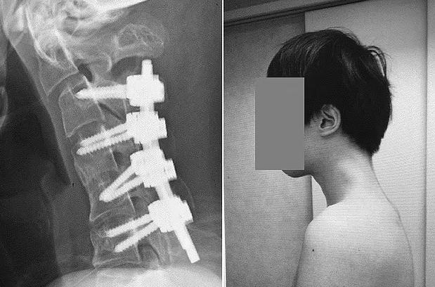 Các nhân viên y tế cuối cùng đã chèn một loạt ốc vít và thanh kim loại vào xương cổ của anh ta để điều chỉnh tư thế của anh ta (trái). Kết quả là sáu tháng sau thủ thuật (phải)