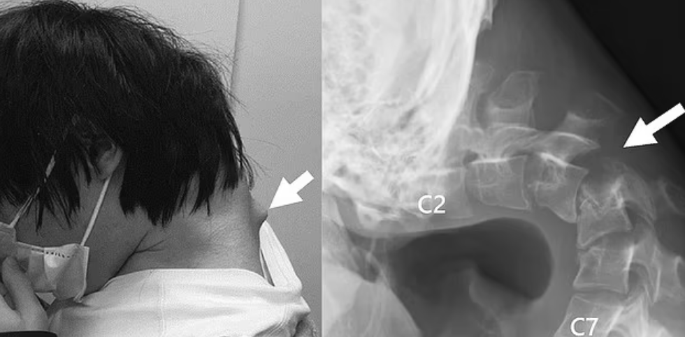 Những bức ảnh gây sốc cho thấy một vết phồng lên từ cổ của anh ta, mà các nhân viên y tế cho rằng các đốt sống của anh ta trở nên 'cực kỳ mở rộng' từ vị trí không tự nhiên