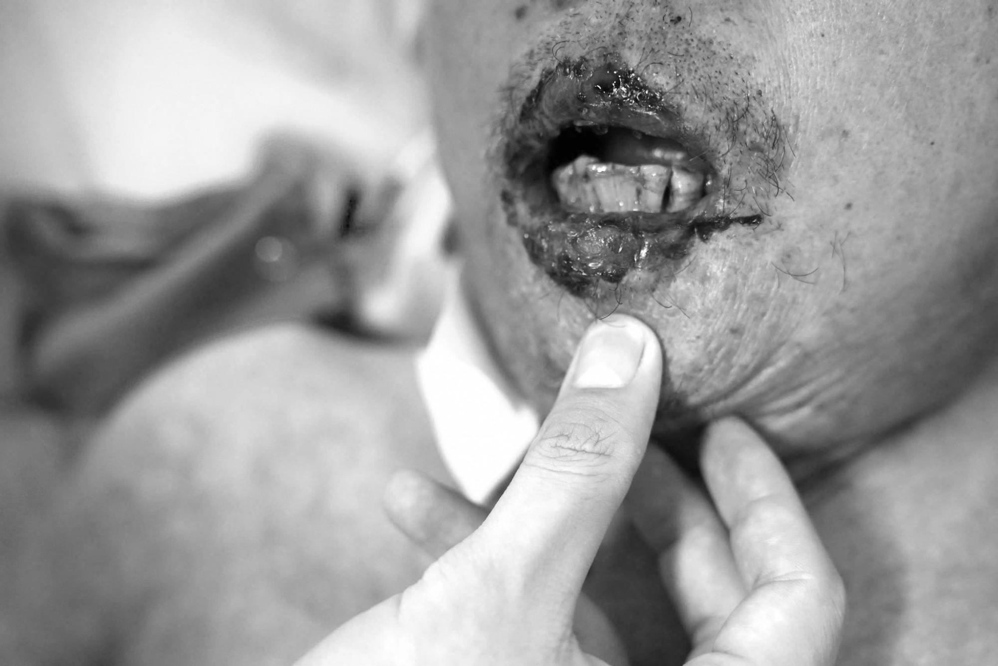 Nam bệnh nhân lở loét khắp người sau khi uống thuốc nam không rõ nguồn gốc