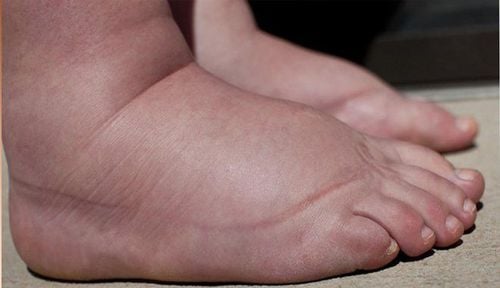 Trẻ đột nhiên bị phù, nặng mi mắt, tiểu máu,... phải nghĩ đến viên cầu thận cấp, ảnh internet