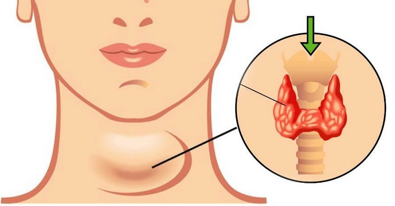Tình trạng cường giáp nếu không được phát hiện sớm có thể gây ra các biến chứng khó lường. Ảnh: Shutter.