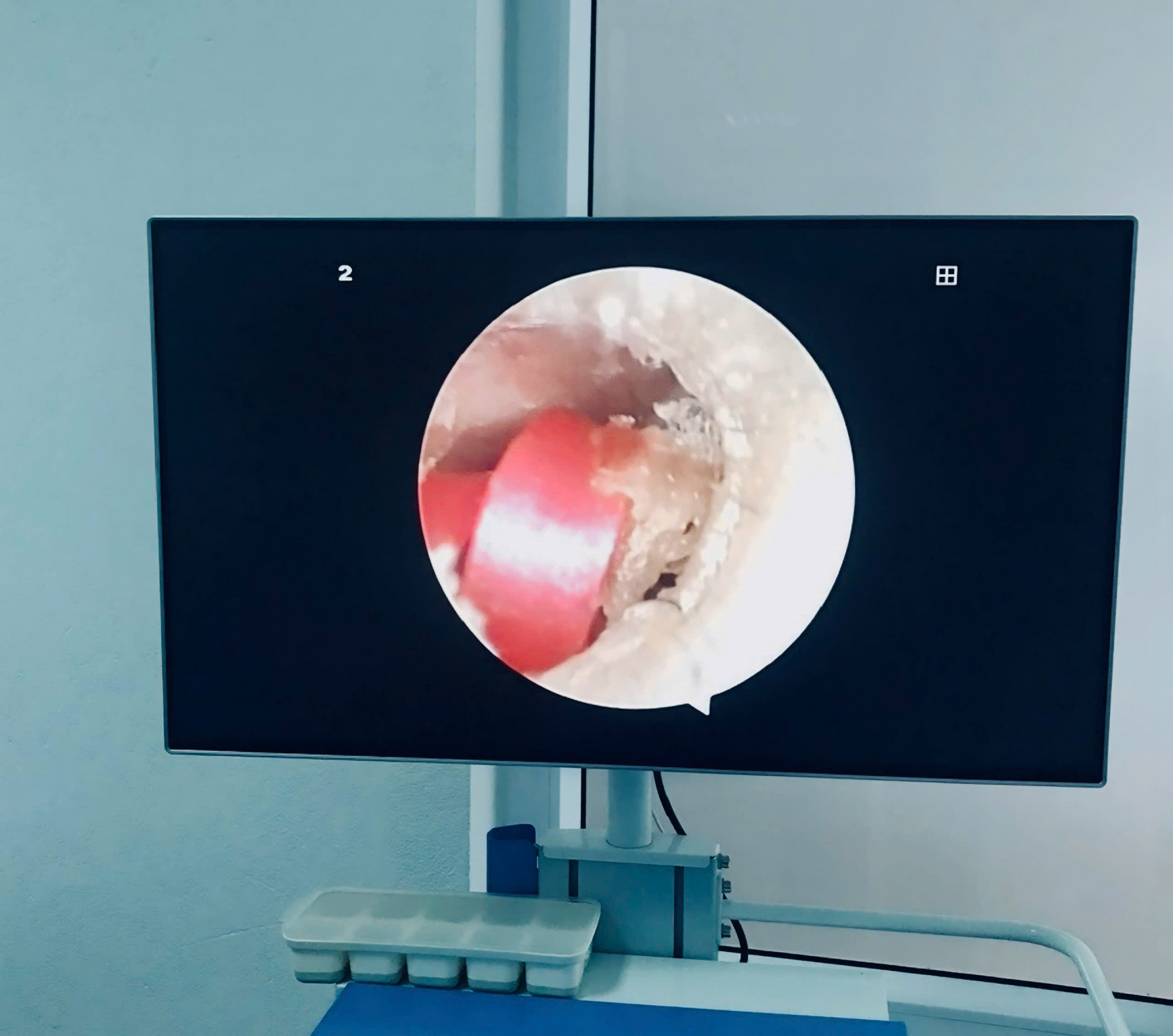 Hình ảnh dây buộc tóc cao su kẹt trong tai trẻ - ảh: BVCC