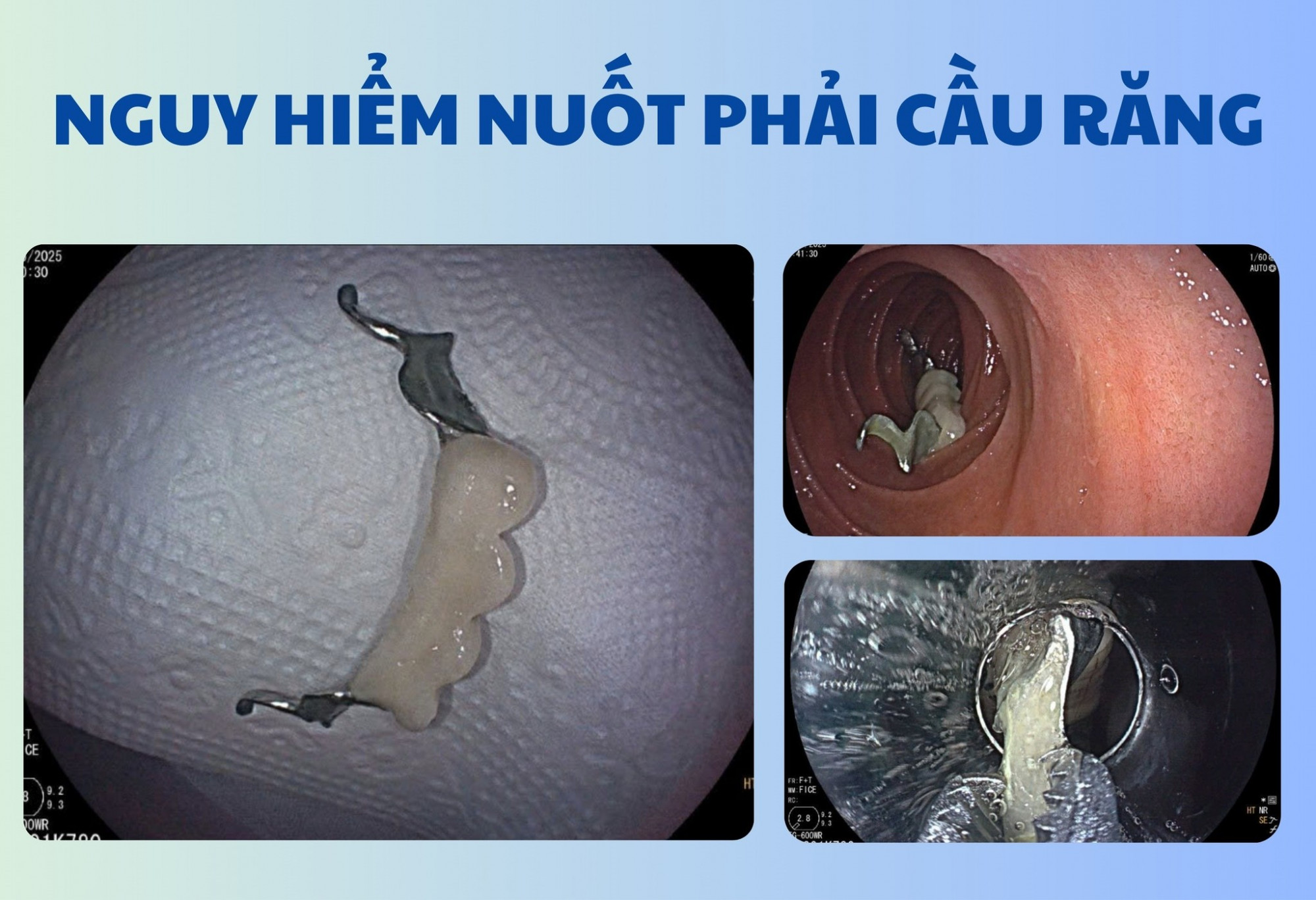 Hình ảnh cầu răng giả rơi vào trong đường tiêu hóa của bệnh nhân - ảnh: BVCC