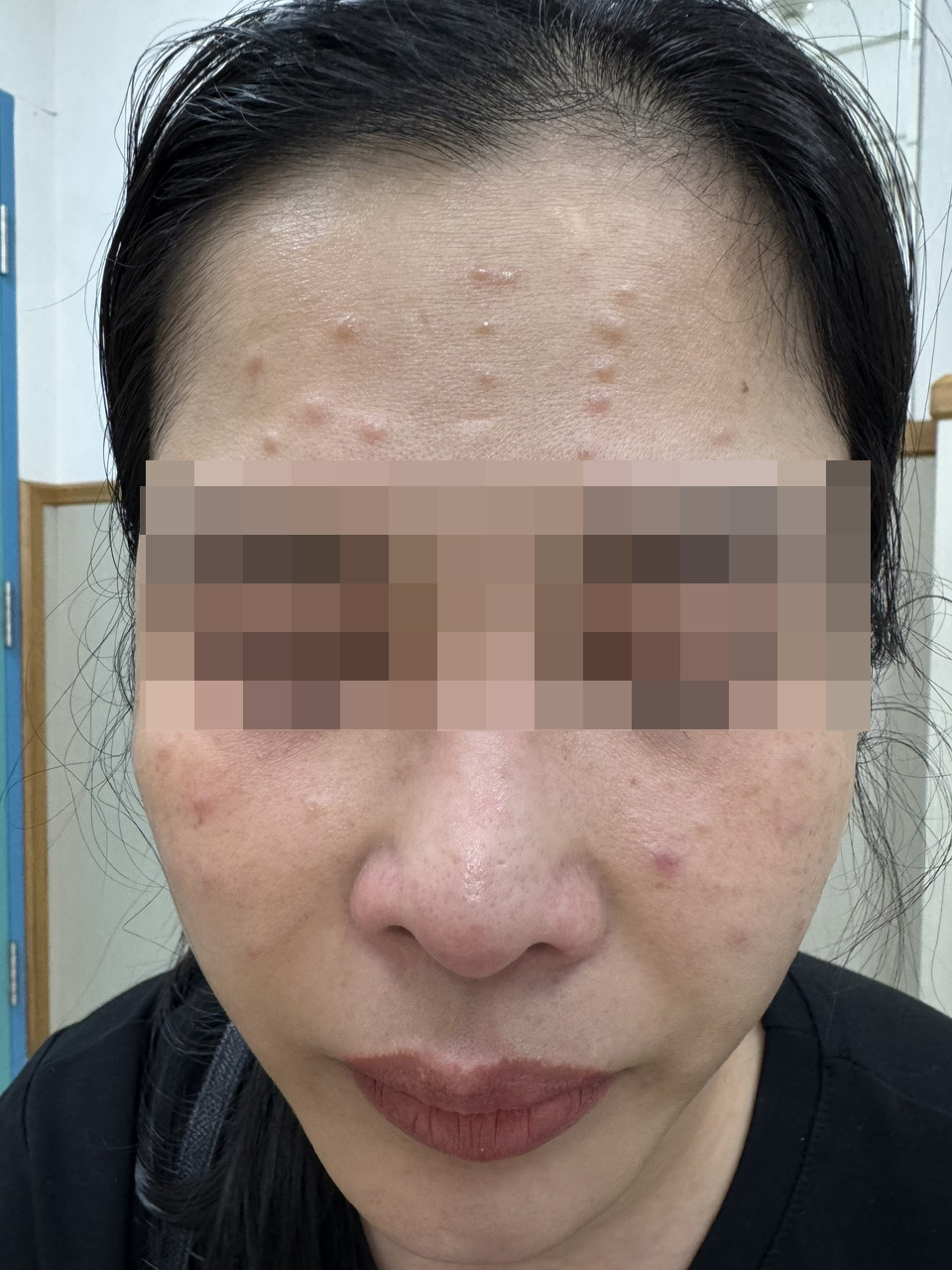 Sau khi tiêm Meso tại một spa, D. bị biến chứng nổi các cục u hạt và được cơ sở làm đẹp này kê thuốc Corticoid liều cao bất chấp hậu quả cho sức khoẻ khách hàng (ảnh bệnh nhân cung cấp)