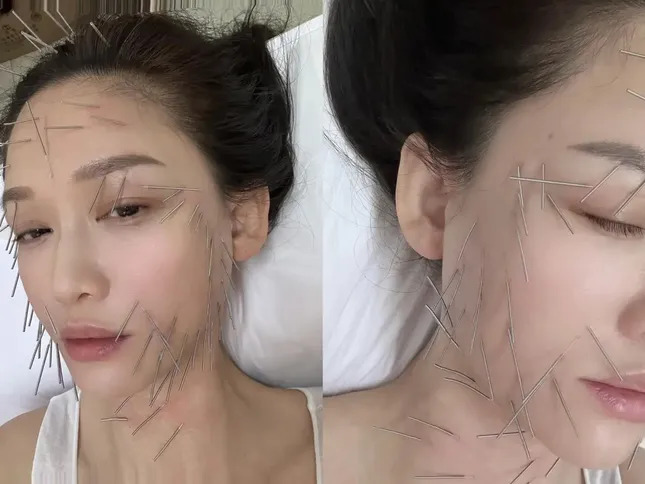 Những phương pháp làm đẹp gây tranh cãi của các ngôi sao